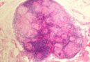 Praktyczne aspekty diagnostyki węzłów chłonnych